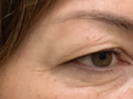 Close-up of the eye area before and after, captured with the same framing
